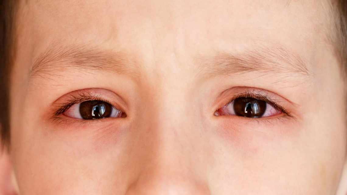 Причини темних кіл під очима у дитини, способи лікування та профілактики