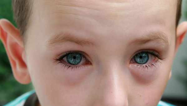 Що робити, якщо у дитини опух і почервоніло око: причини та симптоми набряку