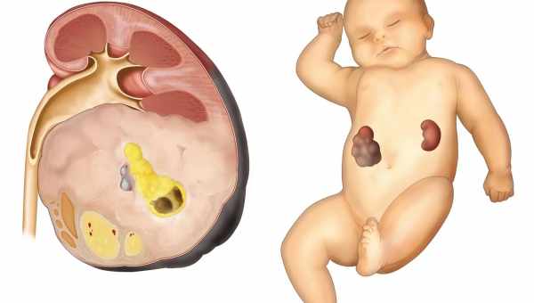 У дитини виявили пухлину Вільмса - прогноз при нефробластомі нирки і лікування