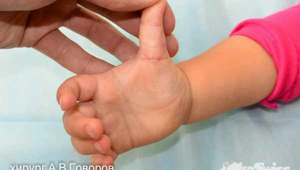 Інфекція «рука-нога-рот» у дітей: лікування синдрому ентеровірусного везикулярного стоматиту