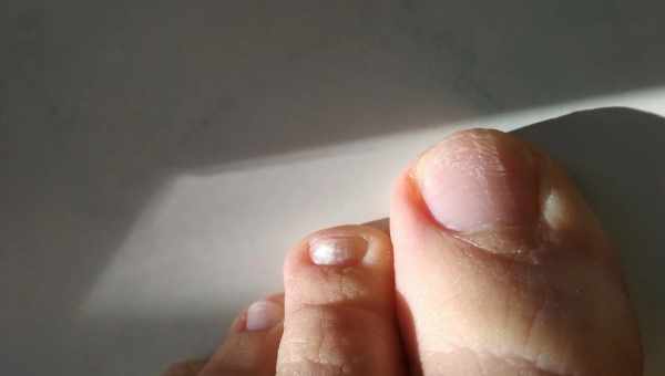 Чому у дитини 1-2 років сильно злояться нігті на руках і ногах: причини та способи лікування