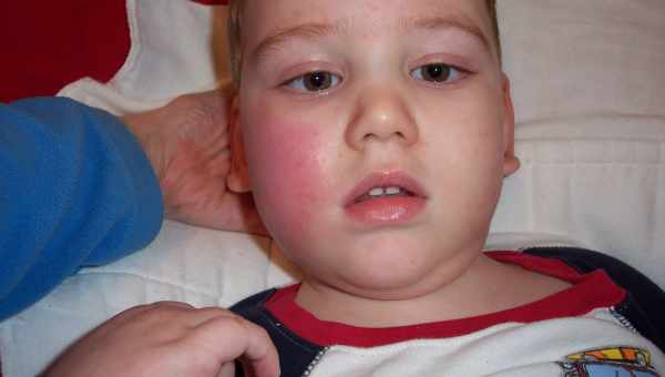 Висипання на тілі у дитини у вигляді прищиків: фото з поясненнями, причини виникнення та лікування